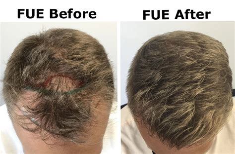 FUE & FUT Hair Transplant .